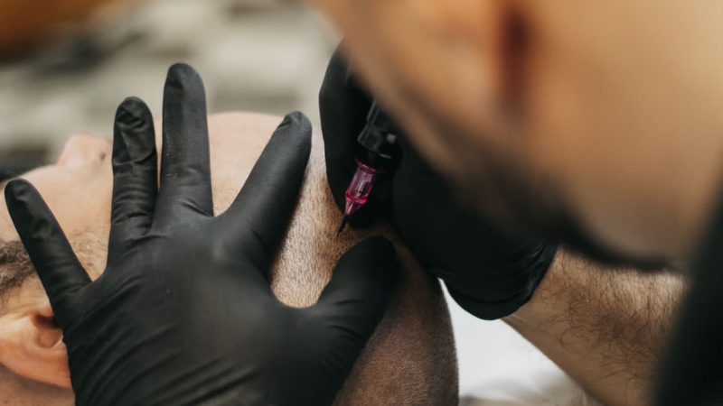 Read more about the article Kako izgleda SMP tretman – korak po korak