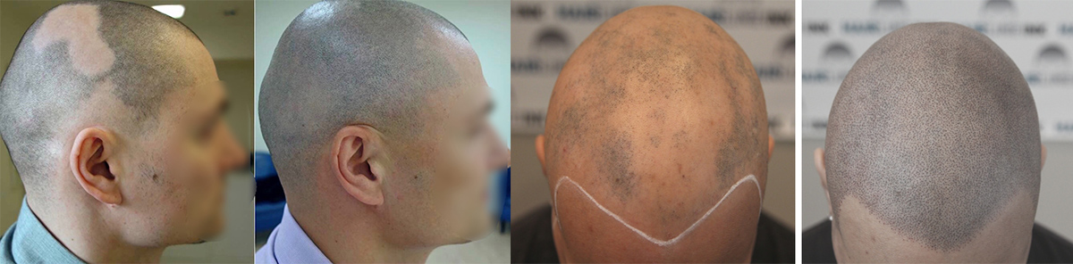 mikropigmentacija kose, mikropigmentacija skalpa, Micro Hair Clinic
