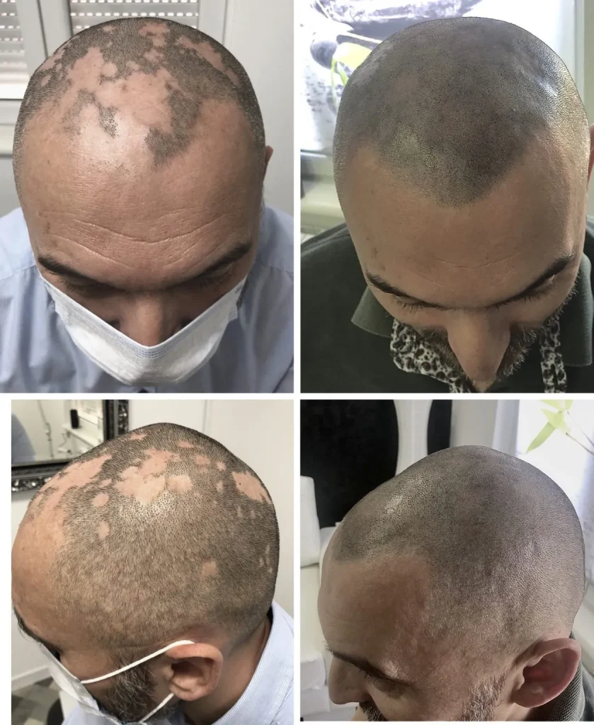 SMP kod alopecije areate – pre i posle