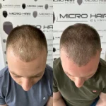 SMP ili transplantacija kose – šta je bolje za mene?