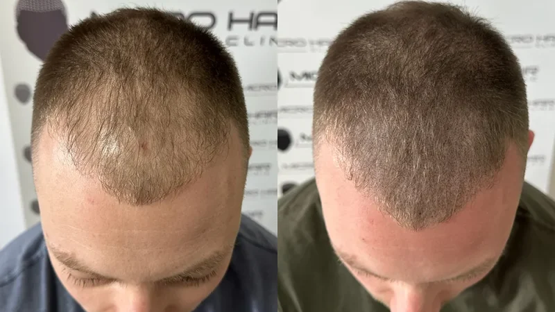 Transplatacija kose i SMP