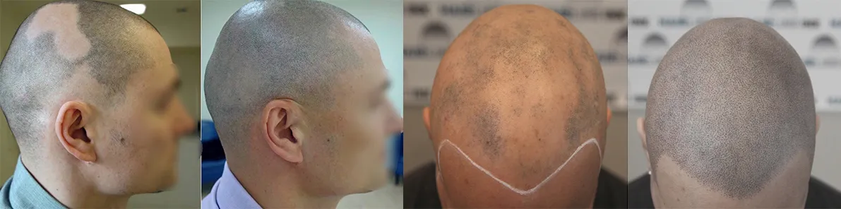 SMP rezultat kod klijenta sa alopecijom areatom