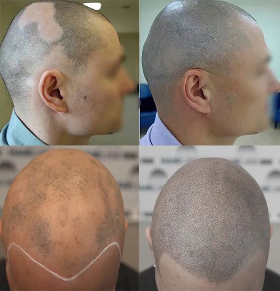 SMP rezultat kod klijenta sa alopecijom areatom